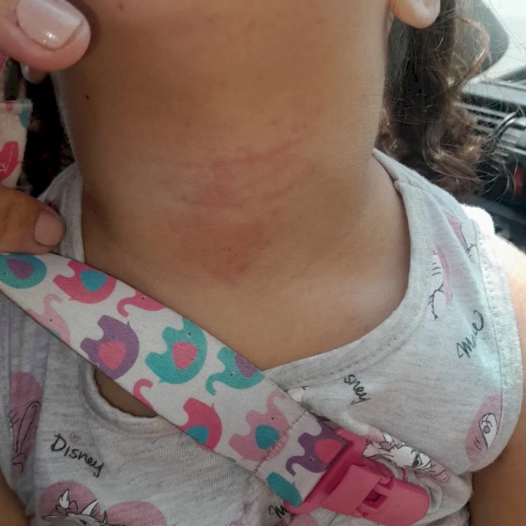 Mãe Denuncia Falta de Atenção em Escola de Marília Durante Crise Alérgica Grave que Poderia Ser Fatal